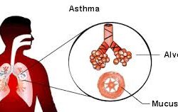 asthma-250x158-1-min